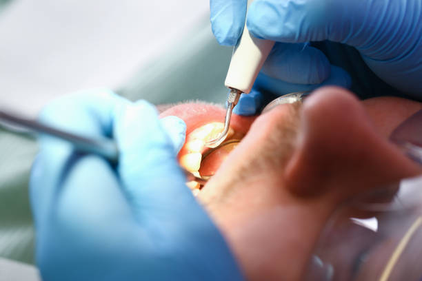 Best Emergency Dentist for Knocked-Out Tooth in Clintwood, VA